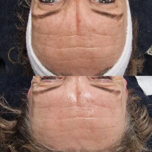 Korean skincare resultaat