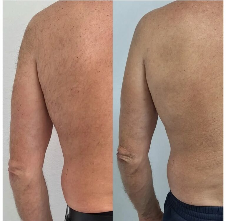 Laser ontharing behandeling